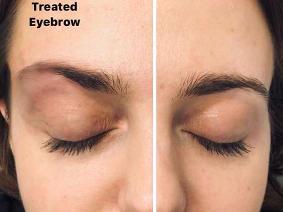 Finally, a no-knife eye lift that actually works!