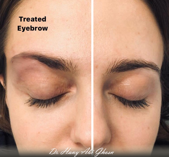 Finally, a no-knife eye lift that actually works!
